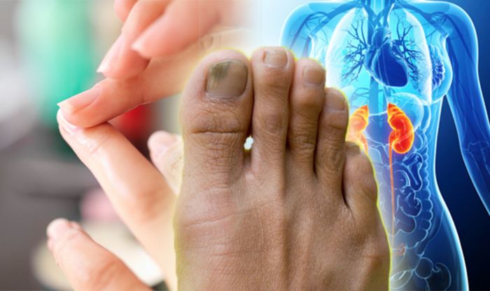 Discoloured Or Yellow Nails Could Be A Symptom Of A Fungal Infection Express Co Uk