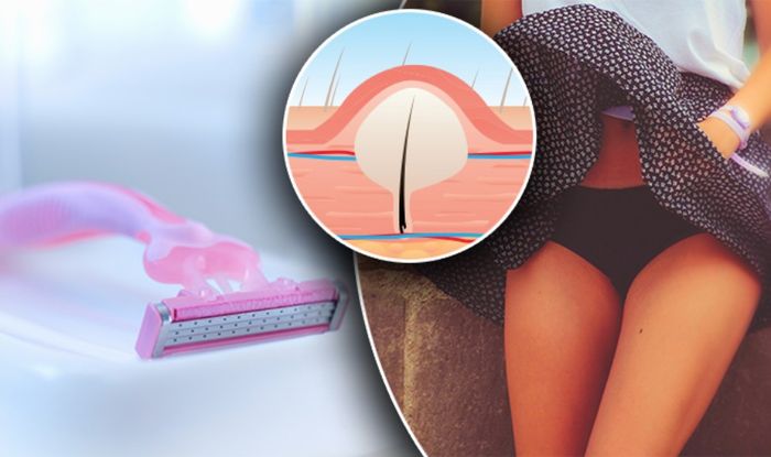 Ingrown Pubic Hair Causes And Treatment Express Co Uk