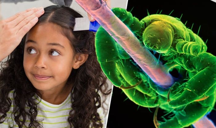 Nits In Your Hair Head Lice Infection Signs Revealed Express Co Uk