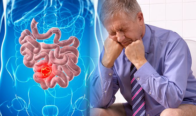 Bowel Cancer Symptoms And Signs Look For This Colour Blood