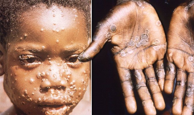 Monkey Pox : Monkeypox Virus In Singapore Symptomen En