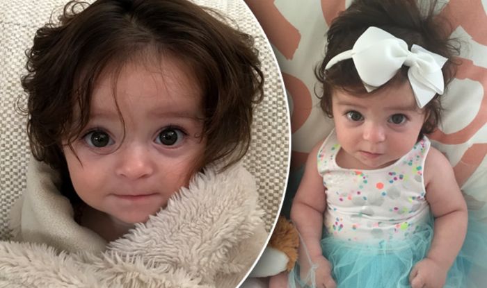 Baby Girl Born With Hairy Forehead Back And Bottom Shocks Parents