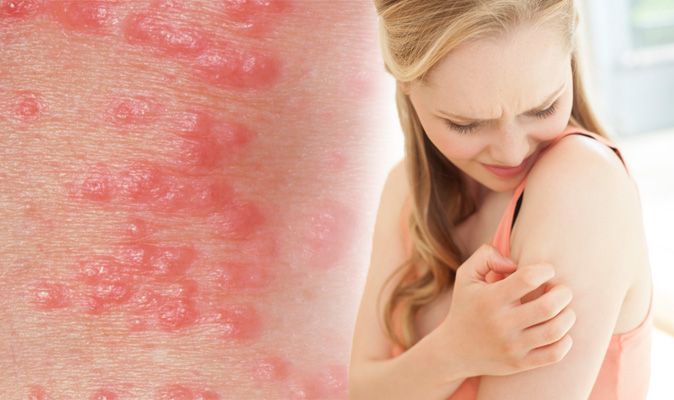 Scabies Rash Three Symptoms Of The Skin Mites And Treatment And