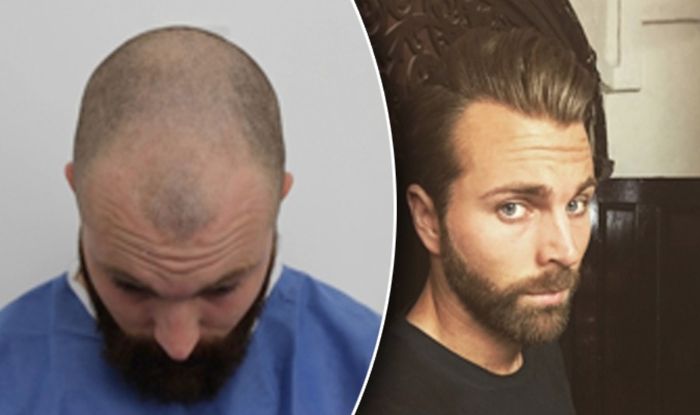 Hair Transplant Gives Barber Who Lost Hair In His Early 20s A New