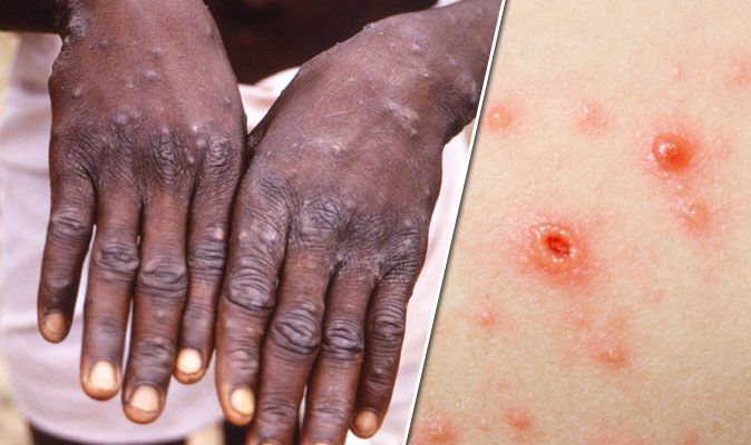 Monkeypox Scars - 3 : Monkeypox is a zoonotic viral disease, endemic in