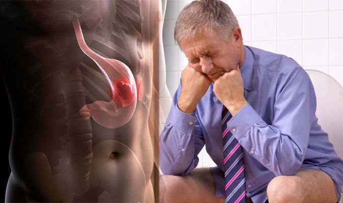 Stomach Cancer Symptoms And Signs Dark Almost Black Poo Could Indicate The Disease Express Co Uk