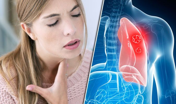 Why Does Lung Cancer Make You Hoarse - CancerWalls