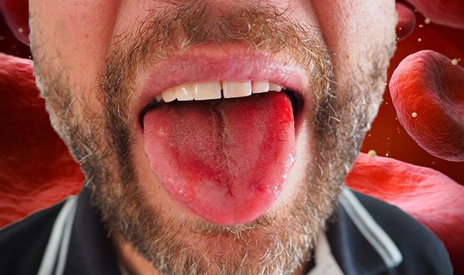 Vitamin B12 Deficiency This Colour Tongue Is One Of The