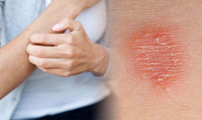 Vitamin D Side Effects Rash Pictures